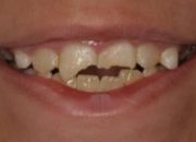 Arti Mimpi Gigi Depan Atas Patah menurut Agama, Psikologi dan Primbon Jawa